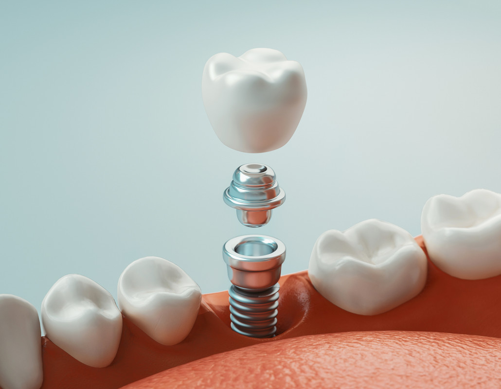 Dental Implants – Procedures and Costs